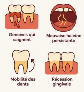signe parodontite